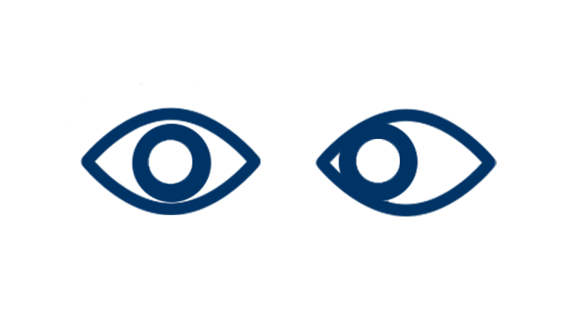 Strabismus Surgery (Four Muscles)