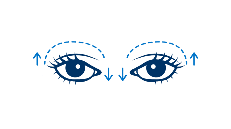 Upper Blepharoplasty (Both Eyes)