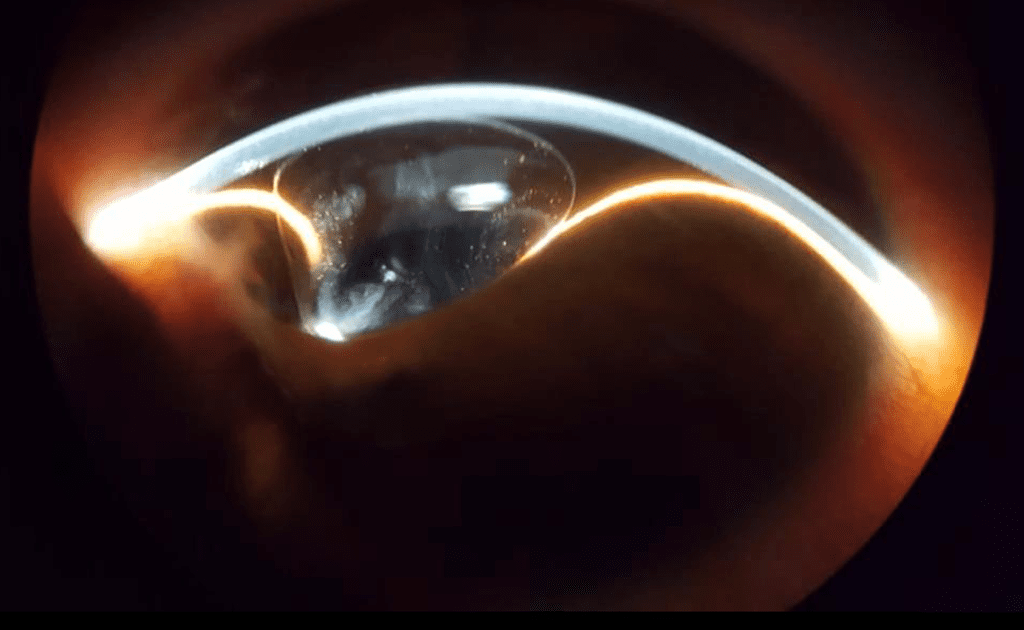 Nora Robledo Iris Bombe Global Specialty Lens Symposium